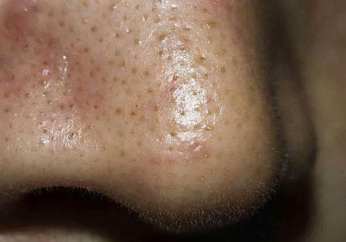 黑头成因及对策全攻略,黑头的形成原因你知道吗