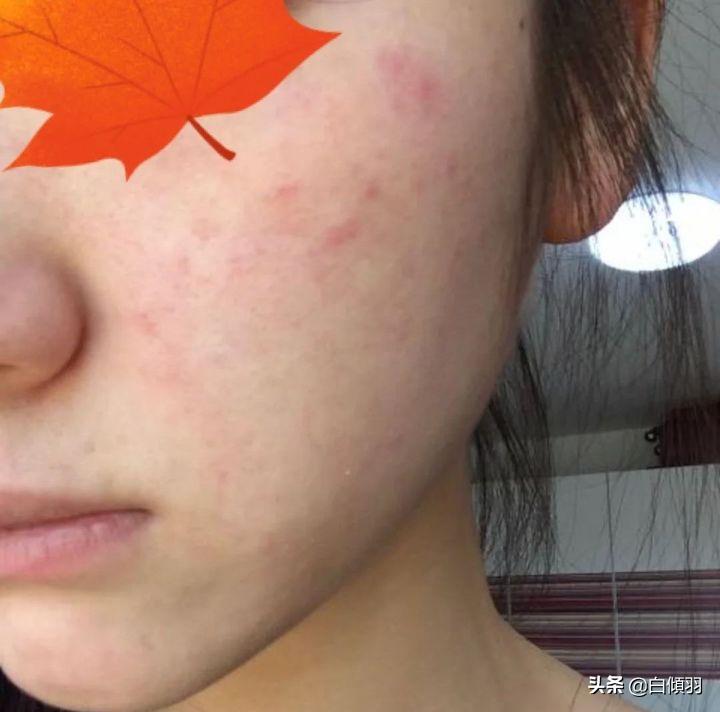 痘痘红肿发硬但是没白色脓头很疼,红肿痘痘疼不冒头也不消怎么办