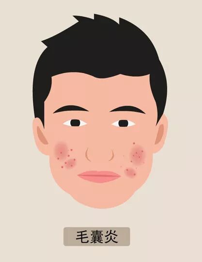 毛囊炎长粉刺和红色疙瘩怎么治疗,白头的红疙瘩是毛囊炎吗