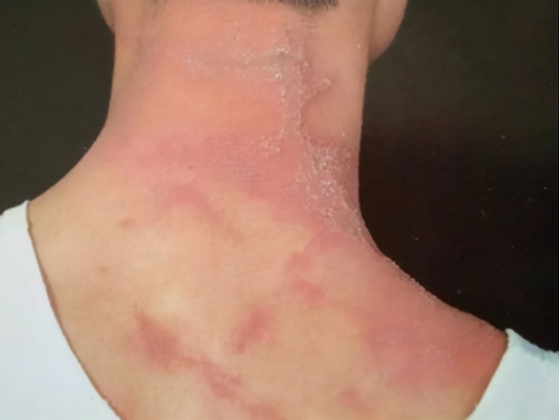 被隐翅虫咬伤有多可怕,被隐翅虫咬后症状图片及治疗方法