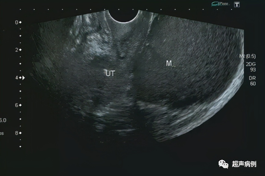 臀部疼痛就诊，超声意外发现这样盆腔包块