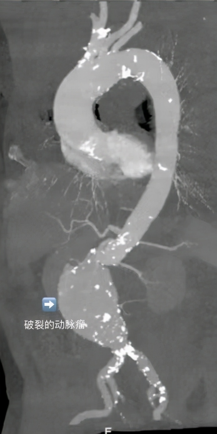 哈医大一院血管外科勇闯高龄禁区凌晨清除84岁老人腹部“血*弹炸**”