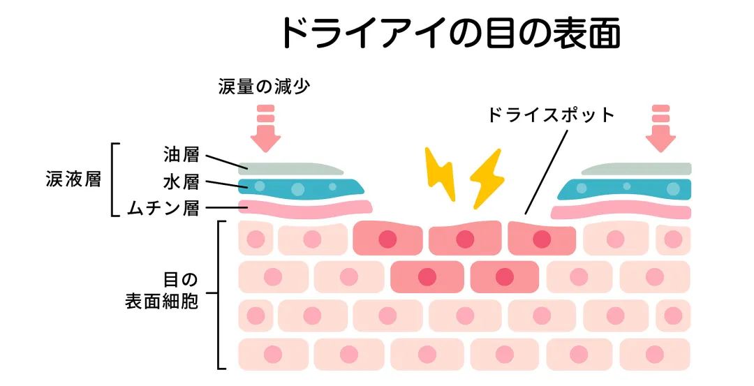 眼霜去眼纹的最好方法,眼纹严重适合的眼霜怎么去掉