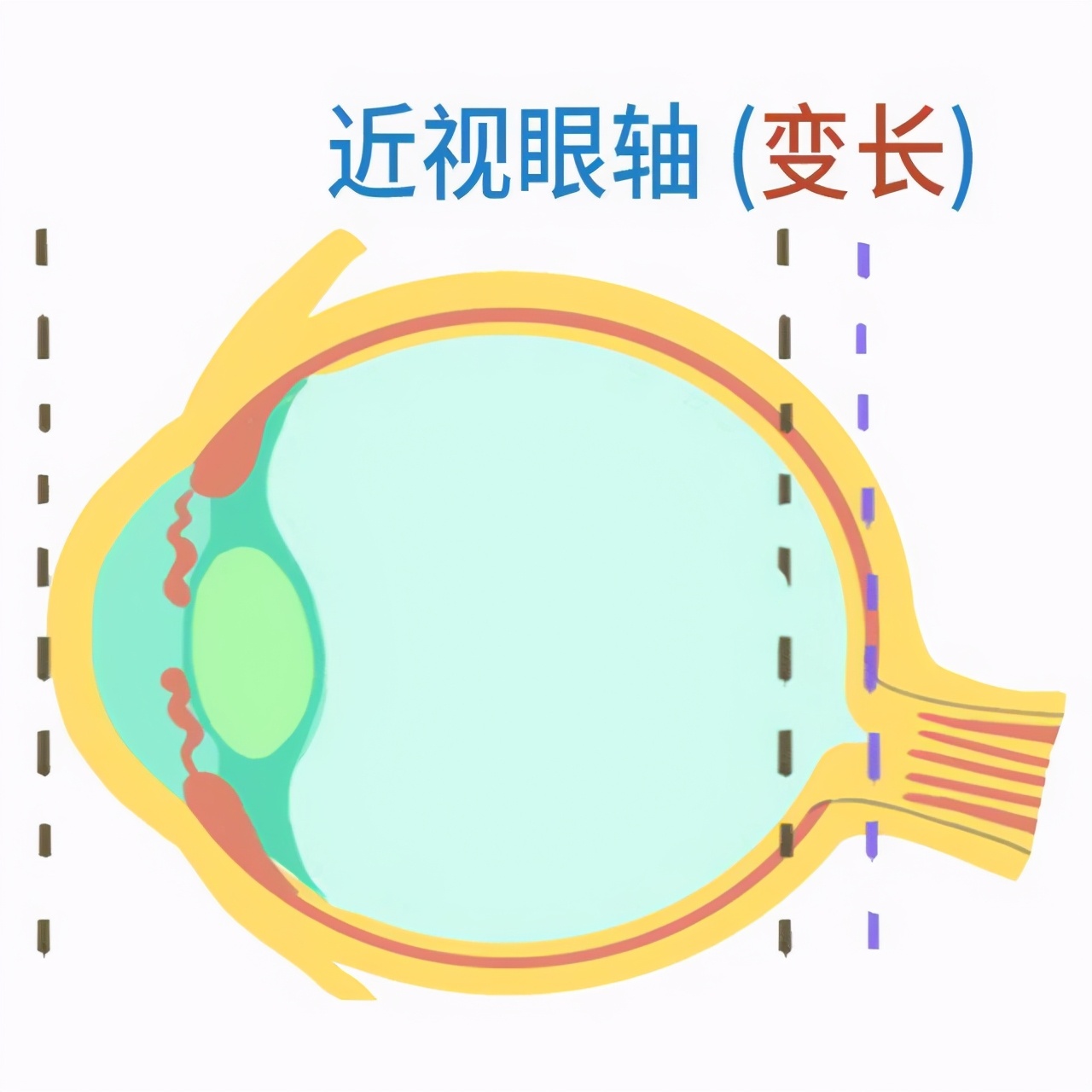 孩子近视了怎么办呀,12岁孩子近视怎么办