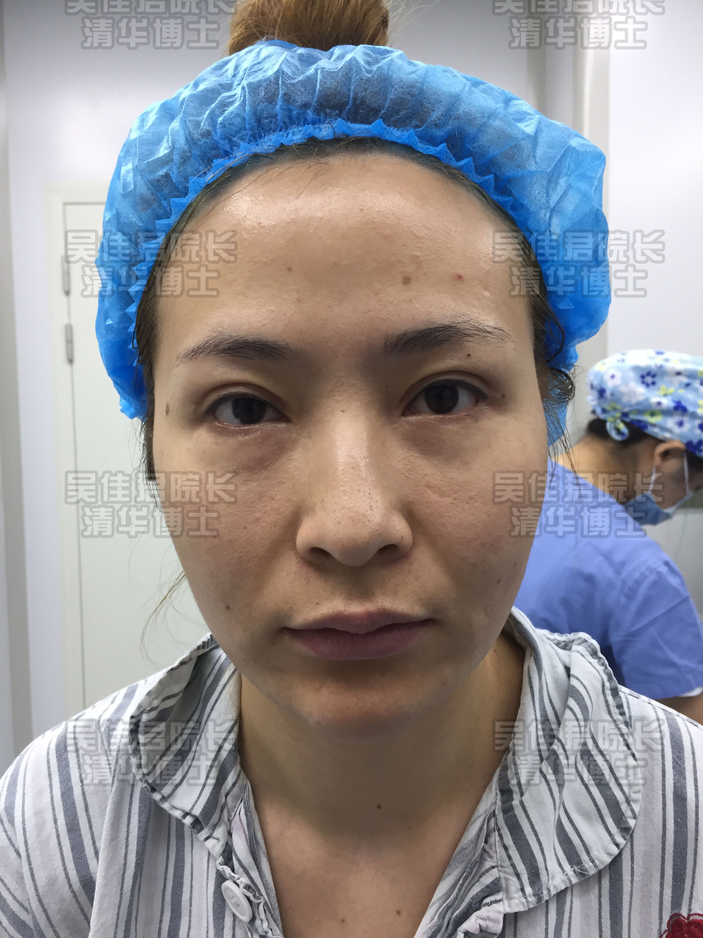 小拉皮手术后真实感受,小拉皮手术后的真实案例