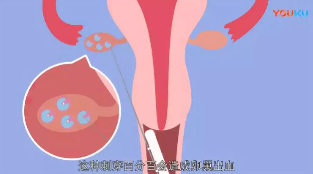 不打麻醉的女人剖腹产,女生不打麻药穿刺痛哭