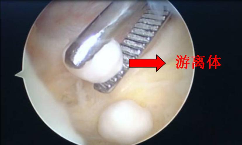 老年人骨性关节炎膝盖疼怎样锻炼,老年人膝关节骨关节炎首选检查
