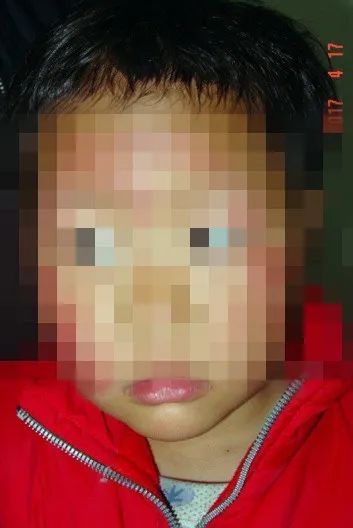 关于蚊虫叮咬引起的皮肤病,最近皮肤容易被蚊虫叮咬