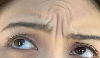 硬刚女皇龙妈也扛不住法令纹，2条沟壑让人心疼，贴一贴就消了