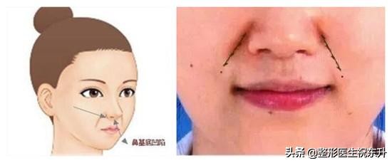 做了很多次医美法令纹还去不掉,法令纹的印子是不是去不掉了