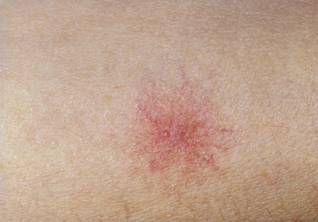 突然全身都长了小红点怎么回事,身上突然有很多小红点是怎么回事