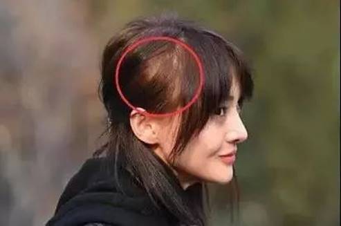 发质偏软m型秃头适合的发型,女生头顶很秃头适合什么发型