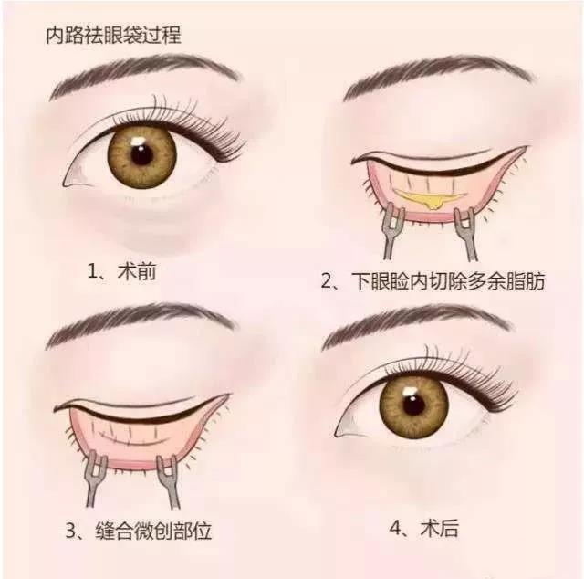 熬夜眼袋八字纹,熬夜带来的眼袋能去除吗