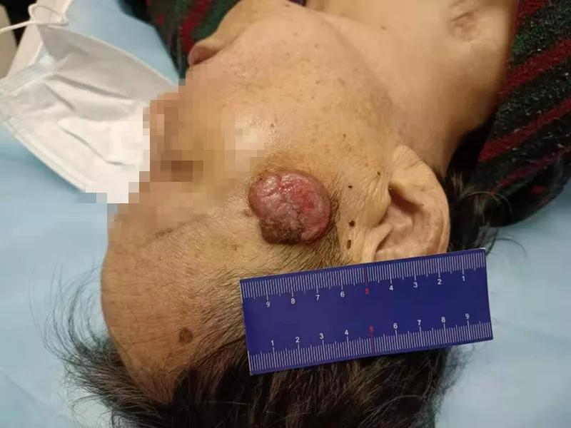 警惕老年斑可能是癌症预兆,什么样的老年斑需要警惕