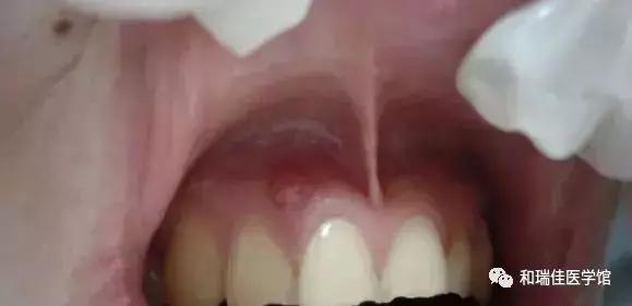 俩牙中间牙龈反复起脓包怎么回事,牙龈反复长脓包怎么消除最快方法