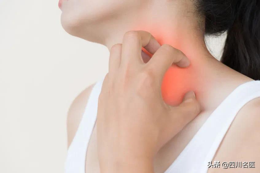 为什么得麻疹,为什么会得荨麻疹原因是什么