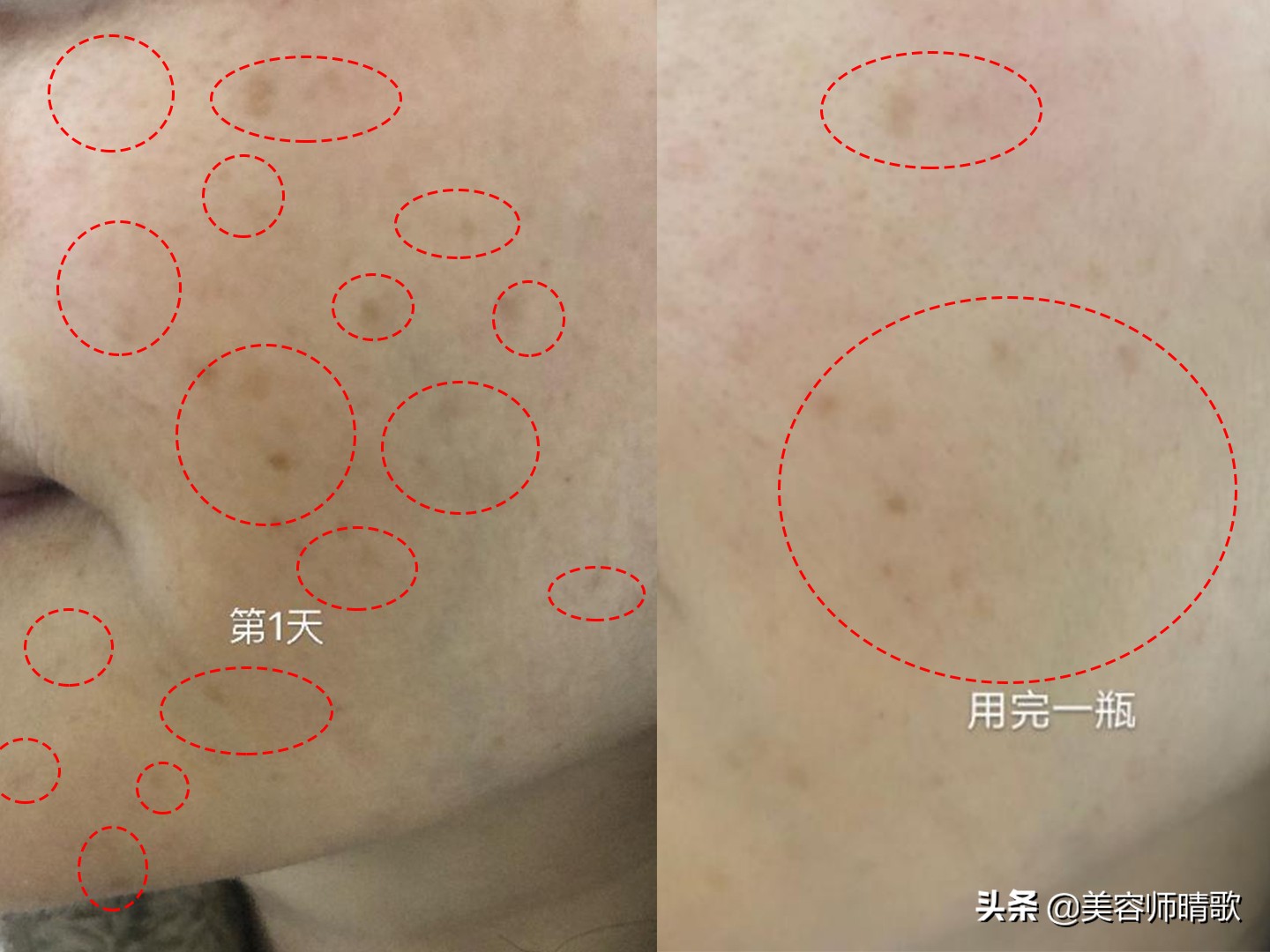 小银瓶淡斑精华推荐,美白淡斑小白瓶精华