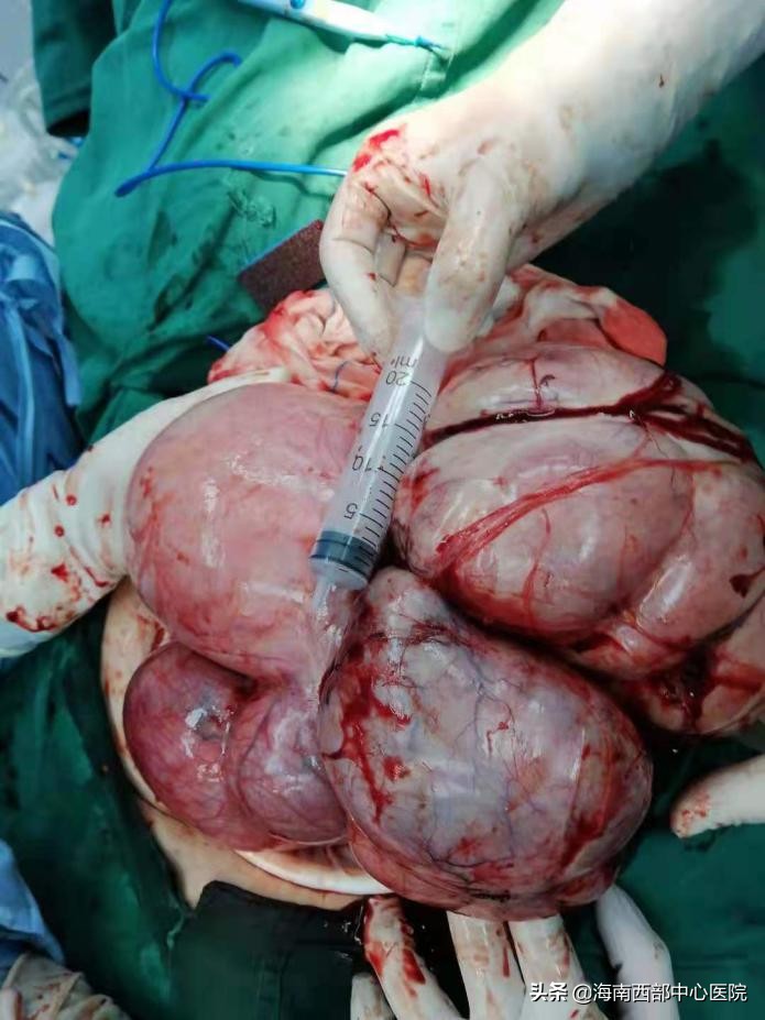 做完子宫肌瘤手术体重下降15斤,摘除肌瘤