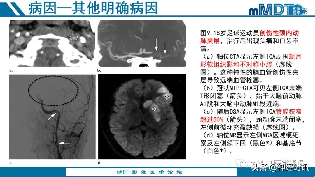 缺血性脑卒中护理课件,缺血性脑卒中讲课ppt
