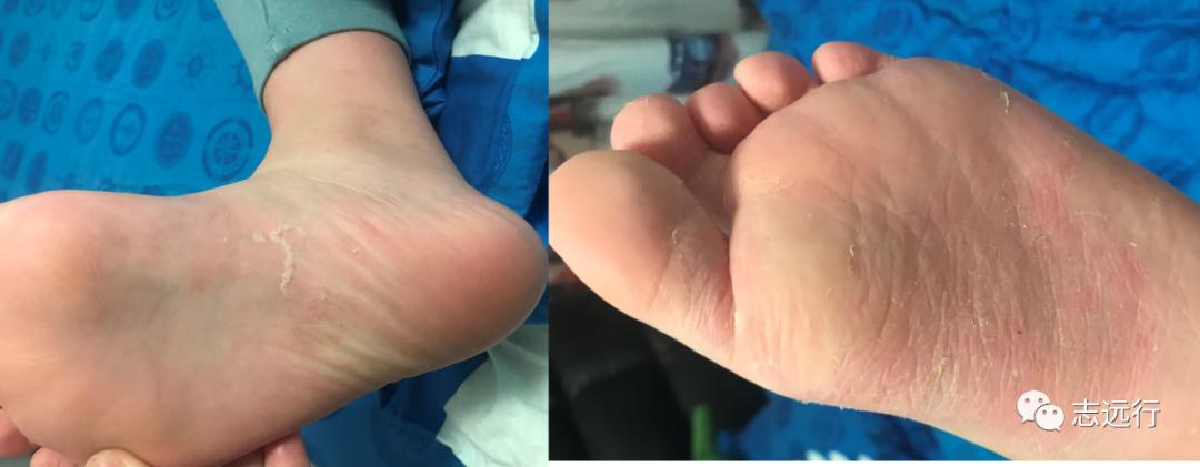 张景明治疗手足癣的中药方,手足癣单方大全