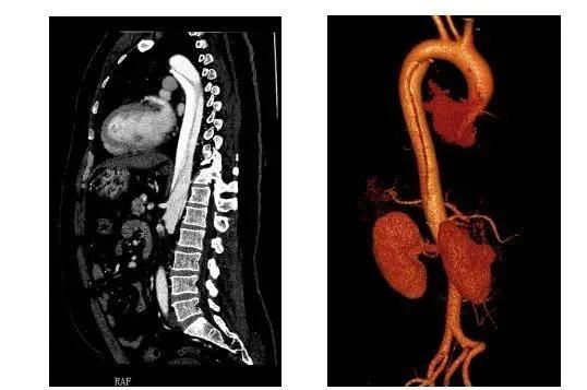 a型主动脉夹层,主动脉夹层撕裂