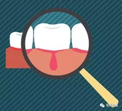 拔牙后如何护理口腔干净,拔牙和种植牙后护理