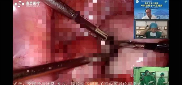 “泰崂巅峰妇有乾坤开拓创新共创辉煌”——记*安泰**市中心医院肿瘤妇科手术直播活动