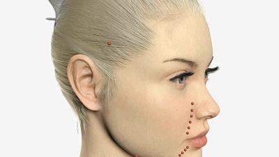 法令纹打玻尿酸还是做线雕效果好,线雕和玻尿酸祛除法令纹哪个好