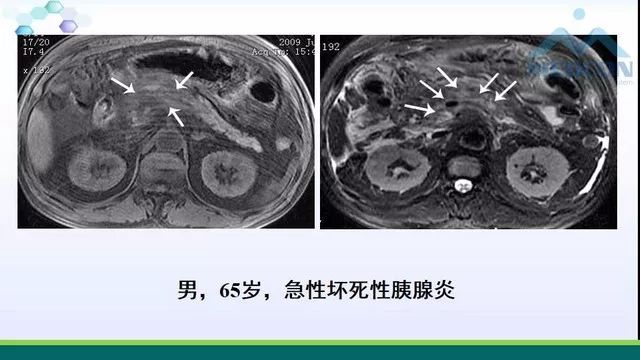 急性胰腺炎的护理措施,急性胰腺炎影像与临床