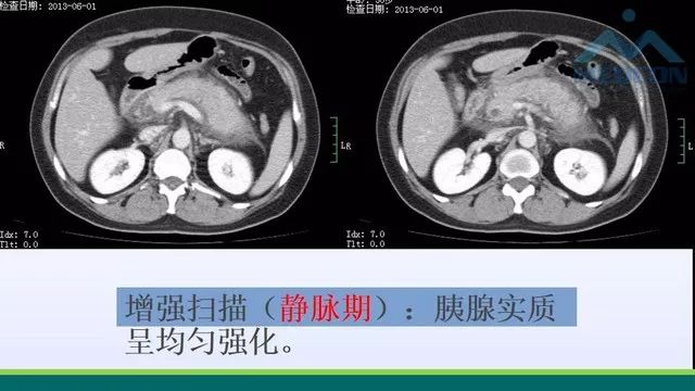 急性胰腺炎的护理措施,急性胰腺炎影像与临床