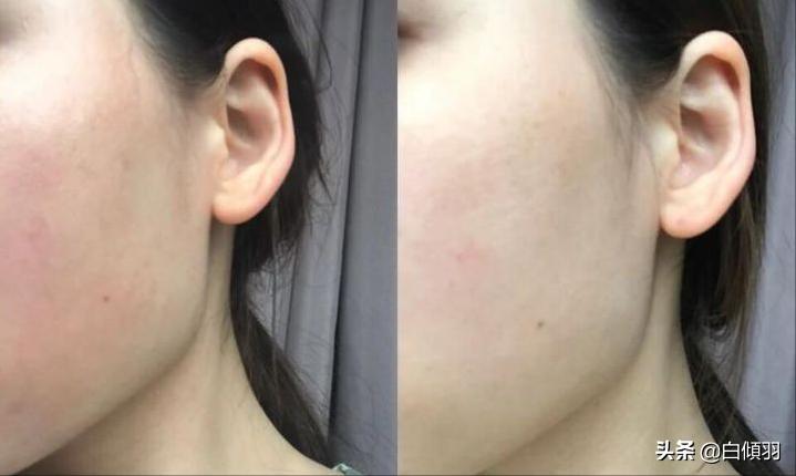 高原气候干燥怎么办,常年高原红怎么修复