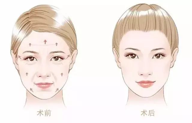 超声刀能抚平皱纹吗,超声刀让人更快衰老吗