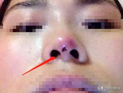 隆鼻鼻子太短了失败,隆鼻失败可以只修复鼻头吗