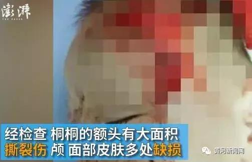 男子被一只狗疯咬,狗被狗咬出血会自愈吗
