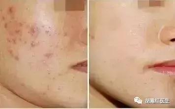 果酸换肤效果特别明显,果酸换肤亲身经历效果好不好