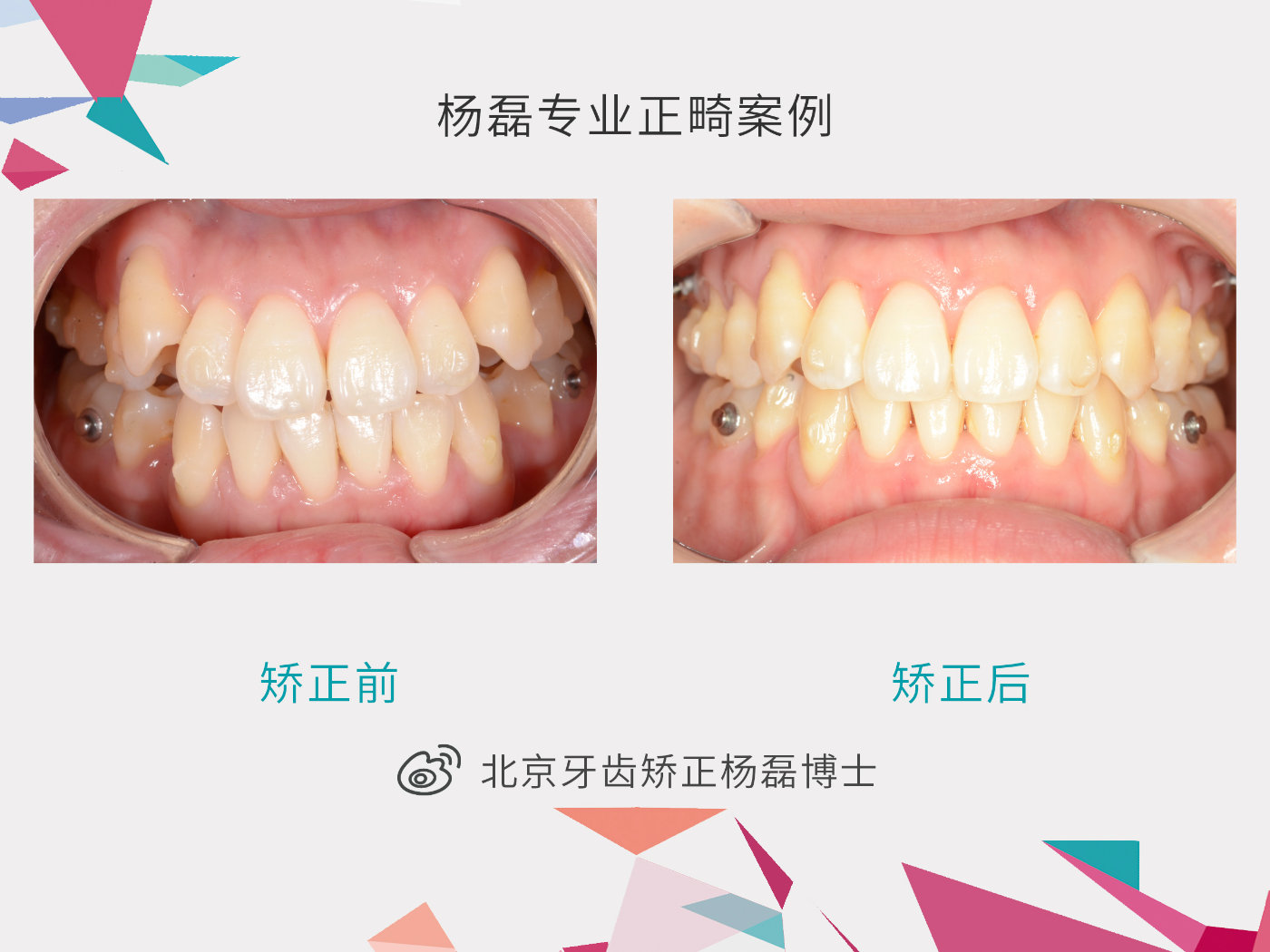 预约北京牙齿矫正流程,北京牙齿矫正哪里比较靠谱