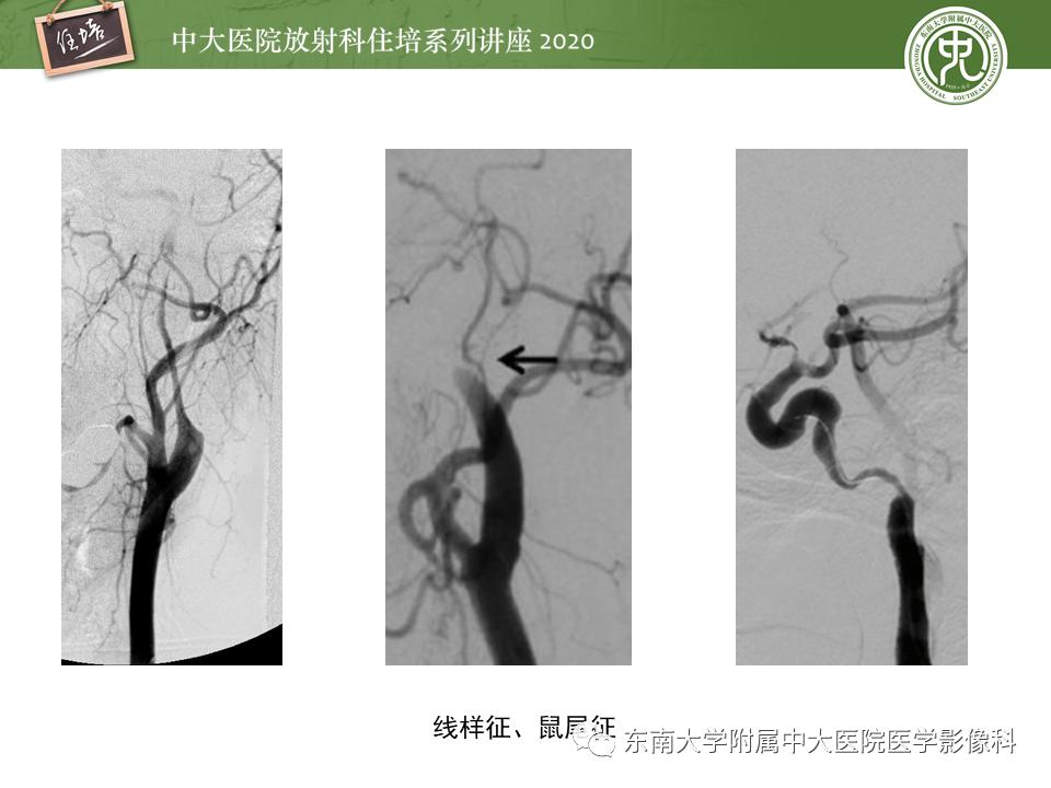 颈动脉夹层的超声表现及漏诊分析,动脉夹层与夹层动脉瘤是一样的吗