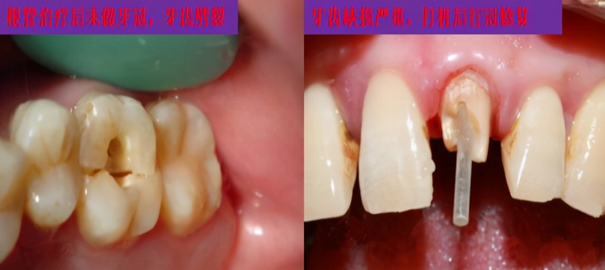 十八岁是矫正牙齿好还是烤瓷牙好,牙齿中线不齐能通过烤瓷牙修复吗