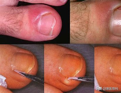 治甲沟炎三招断根,足疗店治甲沟炎一次大概多少钱