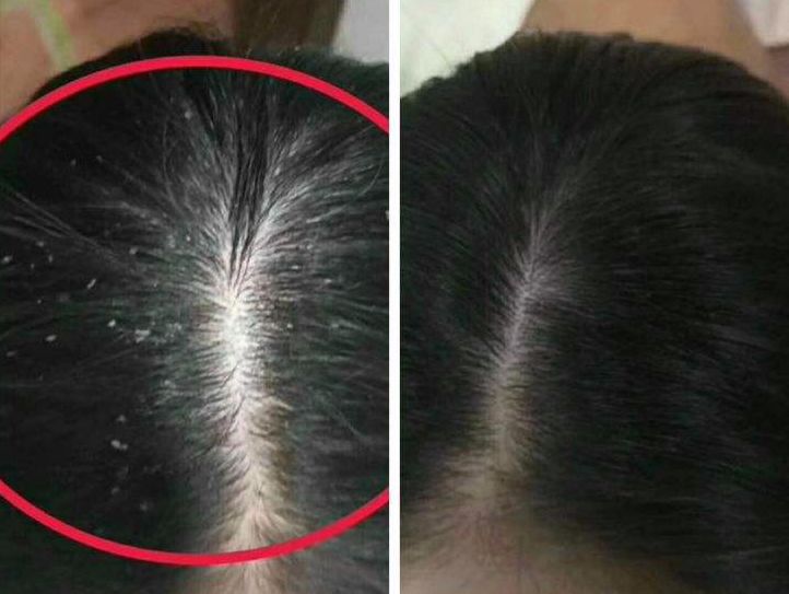 头发毛躁头屑多头皮痒怎么保养,头皮痒头屑多怎么根除