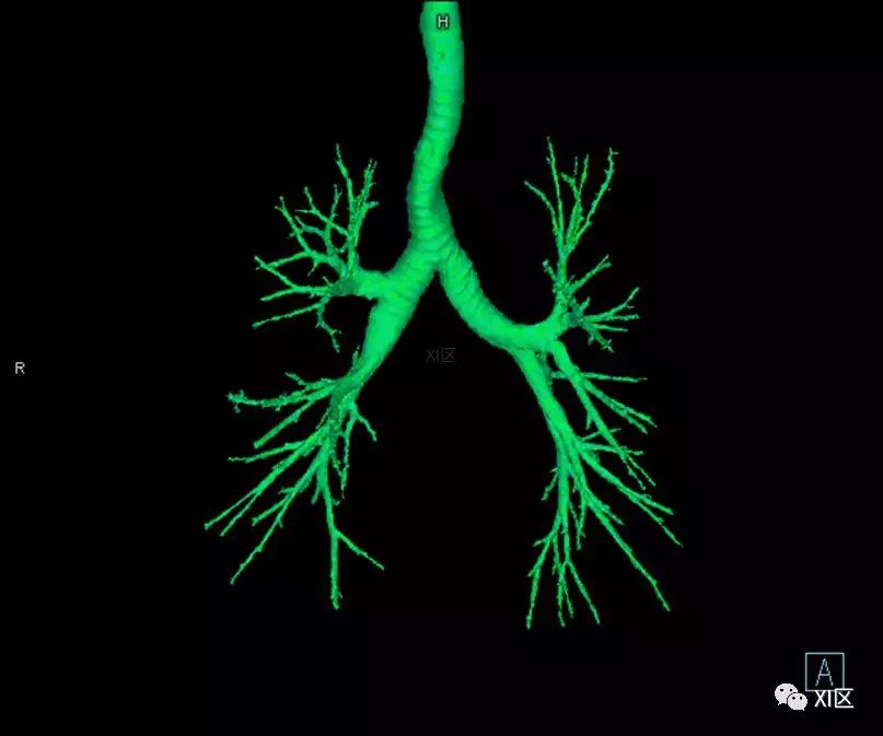 如此详细的肺部影像解剖，有点儿酷