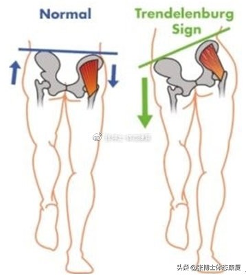 髌骨疼痛综合征最好的解决方法,髌股疼痛综合征最好的辅助治疗是