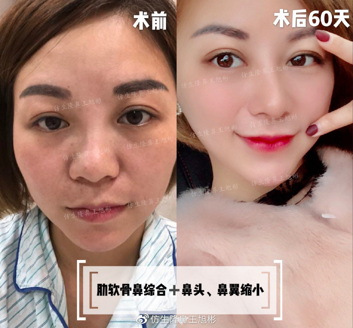 鼻整形最简易方法,鼻孔又大又塌又朝天鼻整形