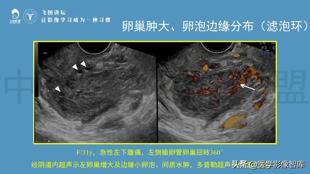 子宫解剖结构输卵管和卵巢位置,子宫附件ct影像学正常解剖表现