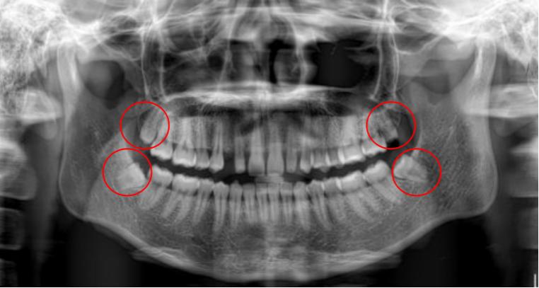 智齿发炎脸肿又感染新冠怎么办,急性智齿发炎脸肿吃什么下火