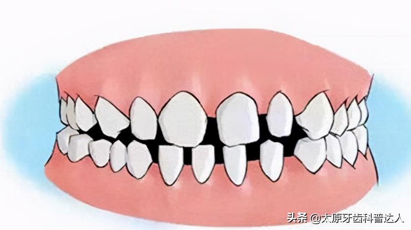 牙齿间隙越来越大是什么原因,牙齿间隙变大是什么原因