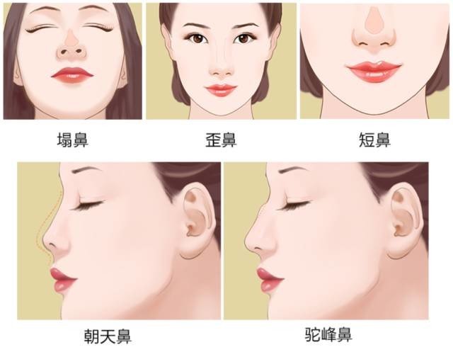 龚忠华：鼻部整形有讲究，你适合哪一种？