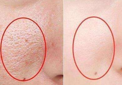 脸上毛孔粗大有什么方法可以修复,脸上毛孔粗大用什么方法最好