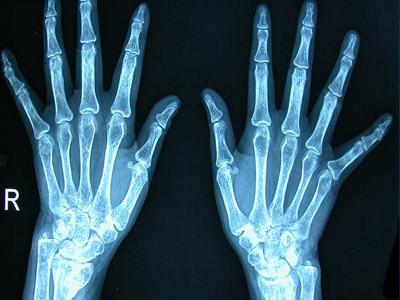 类风湿手指关节痛什么原因,类风湿初期什么症状会得类风湿