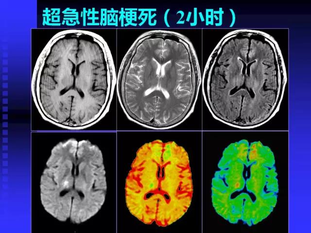 头颅mri读片视频教程,颅脑mri读片入门教程视频讲解全集